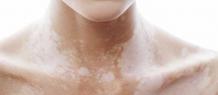 Vitiligo Surgeries in Delhi, Best Vitiligo Specialist Laser Treatment Cost in Delhi