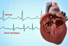 11 Natural Treatments for atrial fibrillation - Herbal Care Products