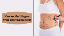 What are the things to avoid before Liposuction? - Skinovate