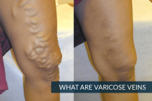 Varicose Veins Laser Treatment in Hyderabad | Varicose Veins