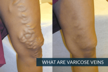 Varicose Veins Causes, Symptoms and Diagnosis | Dr. Abhilash Sandhyala