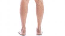 Spider Veins on Legs | Spider Vein Doctors New York, New Jersey, San Diego