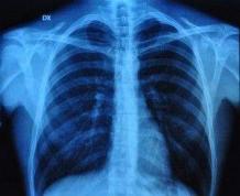 Learn about chronic obstructive pulmonary disease