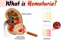 What is Hematuria?