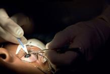 What is Refractive or Lasik Surgery?