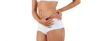 What to Expect After Liposuction – A Look at Recovery and Results