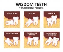 Wisdom Teeth Removal Cost in Delhi - Smileoracles
