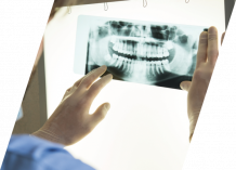 Wisdom Teeth Extraction In Houston TX | Wisdom Teeth Removal Surgery Near me | Oral Surgery