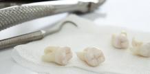 Wisdom Teeth Removal Treatment to Undergo in These 5 Scenarios