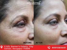 #1 Best Wrinkle Reduction Treatment in Durgapur