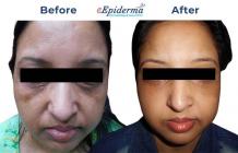 #1 Best Xanthelasma Removal Treatment in Durgapur