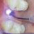 How do implant doctors use dental laser effectively？