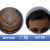 Hair Transplant in Delhi, Cost, Doctor, Hair Clinic South Delhi