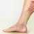 Is it worth getting varicose veins removed?