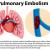 How is pulmonary embolism diagnosed Article - ArticleTed -  News and Articles