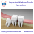 Impacted Wisdom Tooth Extraction