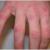 Granuloma Annulare Natural Herbal Treatment by Herbal Care Products - Herbal Care Products