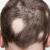 Hair Loss Treatment Singapore