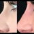 Different Rhinoplasty Procedures - The Four Proven Techniques Used by Rhinoplasty Surgeons Today