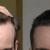 Bio-FUE Hair Transplant | Best Hair transplant in Tirupati