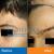 Birthmark Removal Treatment in Pune | Birthmark Removal Near Me