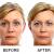 Botox Treatment | Botox Treatment Clinic Delhi | Botox Wrinkles Treatment