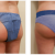 Butt injections in Boston | Butt Lift Surgery with Dermal Fillers