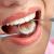 Dental Fillings - The Smile Suite