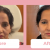 Dermal Fillers in Chandigarh | Dermal Fillers Treatment in Chandigarh