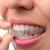      Invisalign in Brooklyn to Straighten Your Teeth