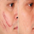 Surgery For Facial Scars - Moving Towards a Scarless Society