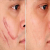 Facial Acne Scar Treatments - Effective Face Scar Removal Methods