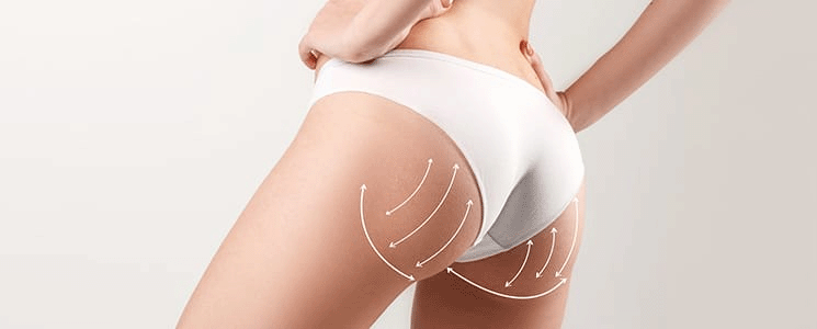 Fat Transfer in San Diego | Allurant Medical