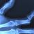 How challenging is bone dislocation to an orthopedic surgeon? omg blog