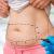 What is the Difference Between a Full Tummy Tuck and a Mini Tummy Tuck?