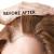 Hair loss treatment in bangalore | The Body Perfect Cosmetic Clinic