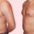 Male Breast Reduction Surgery In Delhi | Gynecomastia Surgery In Delhi