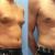 Top Gynecomastia Surgery in Pune, PCMC - Dr. Shilpy Dolas