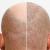 Best Hair Transplant in Delhi, Cost of Hair Transplant Surgery in Delhi