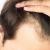 Hair Transplant Hyderabad-Hair Transplant Hyderabad Cost