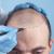 Best Hair Transplant in Delhi