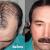 FUE Hair Transplant in Islamabad 