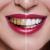 Porcelain Veneers: Five Reasons To Choose Them.  - by veneersdentist - veneersdentist