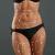 Are Liposuction Surgery Results Permanent?