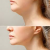 Double Chin Liposuction Procedure