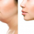 Kybella Treatment for Double Chin