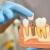 Know The Average Cost Of Getting Dental Implants