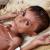 malnourished child symptoms