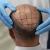 Cost Of Hair Transplant In Kolkata: What To Expect?