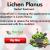 Herbal Care Products: Natural Remedies for Lichen Planus and Foods to Avoid